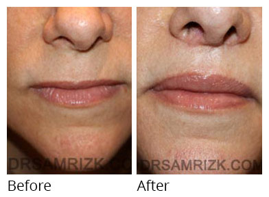 Woman's face, before and after Lip Lift treatment, front view, patient 2