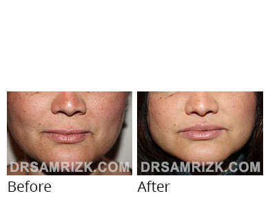Woman's face, before and after Lip Lift treatment, front view, patient 3