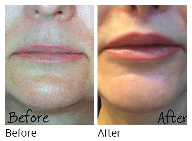 Woman's face, before and after Lip Lift treatment, front view, patient 4