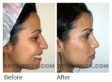 Female face, before and after Rhinoplasty treatment, side view, patient 1