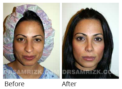Female face, before and after Rhinoplasty treatment, front view, patient 1