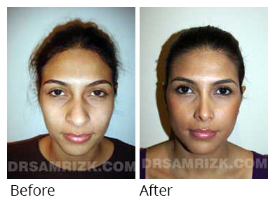 Female face, before and after Rhinoplasty treatment, front view, patient 2