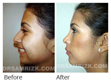 Female face, before and after Rhinoplasty treatment, side view, patient 2