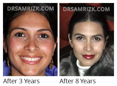 Female face, 3 / 8 years after Rhinoplasty treatment, front view, patient 2