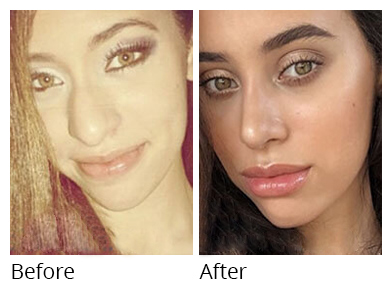 Female face, before and after Rhinoplasty treatment, front view, patient 3