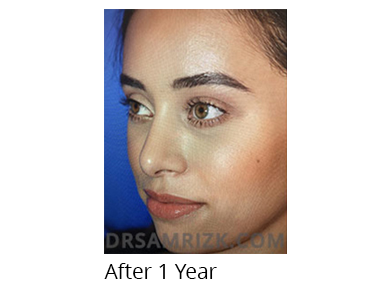 Female face, 1 year after Rhinoplasty treatment, oblique view, patient 3