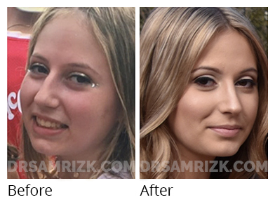 Female face, before and after Rhinoplasty treatment, oblique view, patient 4