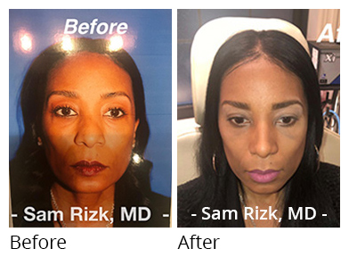 Female face, before and after Rhinoplasty treatment, front view, patient 5