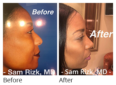 Female face, before and after Rhinoplasty treatment, side view, patient 5
