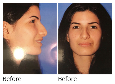Female face, before Rhinoplasty treatment, side and front view, patient 6