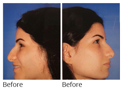 Female face, before Rhinoplasty treatment, side view, patient 6