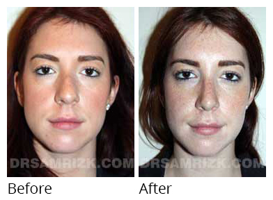 Female face, before and after Rhinoplasty treatment, front view, patient 7