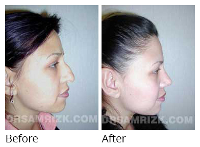 Female face, before and after Rhinoplasty treatment, side view, patient 8