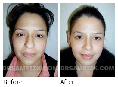 Female face, before and after Rhinoplasty treatment, front view, patient 8