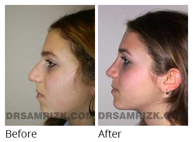 Female face, before and after Rhinoplasty treatment, side view, patient 10