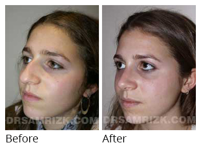 Female face, before and after Rhinoplasty treatment, oblique view, patient 10