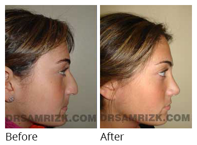 Female face, before and after Rhinoplasty treatment, side view, patient 11