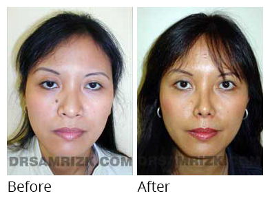 Female face, before and after Rhinoplasty treatment, front view, patient 12