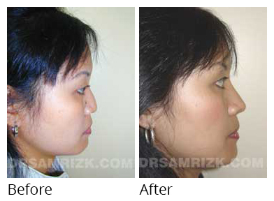 Female face, before and after Rhinoplasty treatment, side view, patient 12