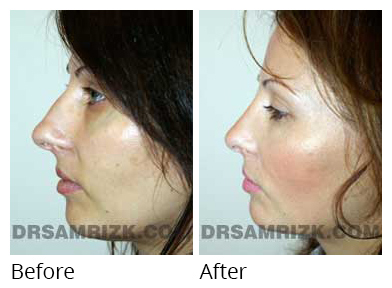 Female face, before and after Rhinoplasty treatment, side view, patient 13