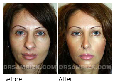 Female face, before and after Rhinoplasty treatment, front view, patient 13