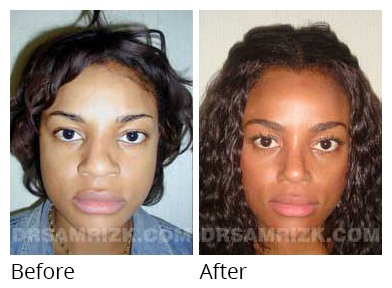 Female face, before and after Rhinoplasty treatment, front view, patient 14