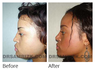 Female face, before and after Rhinoplasty treatment, side view, patient 14