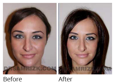 Female face, before and after Rhinoplasty treatment, front view, patient 15
