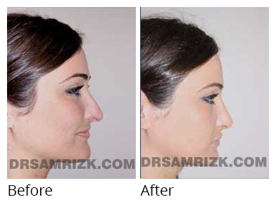 Female face, before and after Rhinoplasty treatment, side view, patient 15