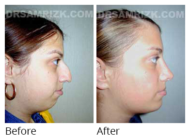 Female face, before and after Rhinoplasty treatment, side view, patient 16