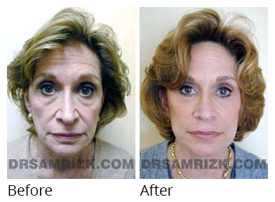 Female face, before and after Rhinoplasty treatment, front view, patient 17
