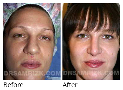 Female face, before and after Rhinoplasty treatment, front view, patient 18
