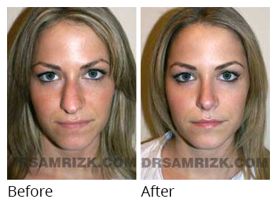Female face, before and after Rhinoplasty treatment, front view, patient 19