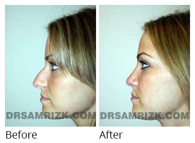 Female face, before and after Rhinoplasty treatment, side view, patient 19