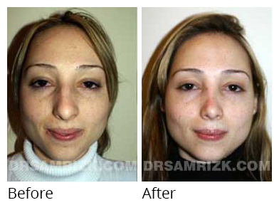Female face, before and after Rhinoplasty treatment, front view, patient 20