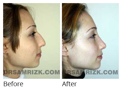 Female face, before and after Rhinoplasty treatment, side view, patient 20