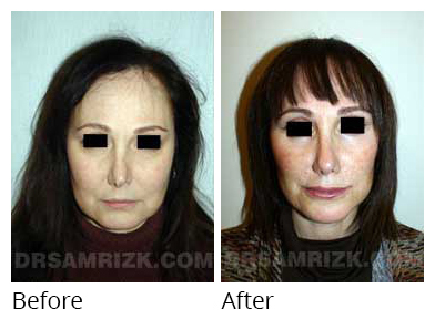 Female face, before and after Rhinoplasty treatment, front view, patient 21
