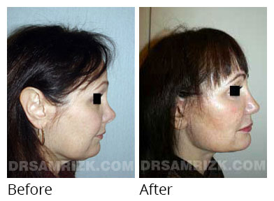 Female face, before and after Rhinoplasty treatment, side view, patient 21