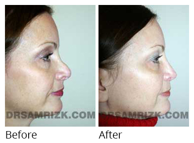 Female face, before and after Rhinoplasty treatment, side view, patient 22