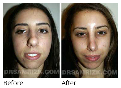 Female face, before and after Rhinoplasty treatment, front view, patient 23