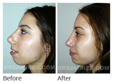 Female face, before and after Rhinoplasty treatment, side view, patient 23