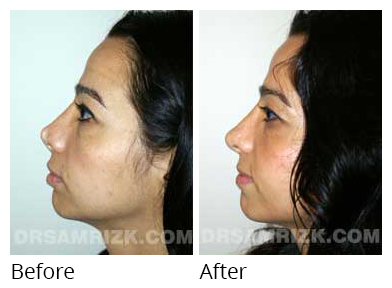 Female face, before and after Rhinoplasty treatment, side view, patient 24