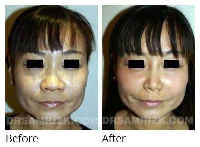Female face, before and after Rhinoplasty treatment, front view, patient 25