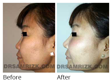 Female face, before and after Rhinoplasty treatment, side view, patient 25