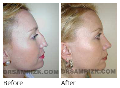 Female face, before and after Rhinoplasty treatment, front view, patient 26