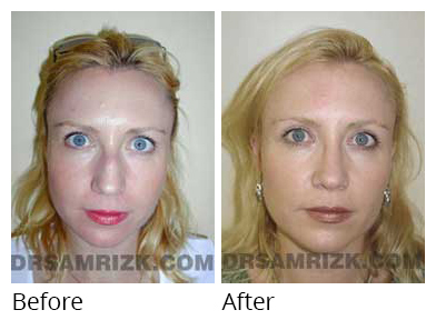 Female face, before and after Rhinoplasty treatment, side view, patient 26
