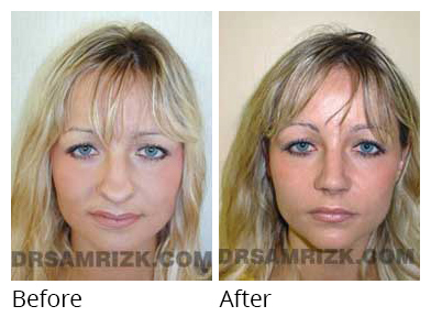 Female face, before and after Rhinoplasty treatment, front view, patient 27