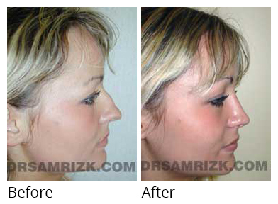 Female face, before and after Rhinoplasty treatment, side view, patient 27
