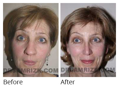 Female face, before and after Rhinoplasty treatment, front view, patient 28