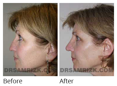 Female face, before and after Rhinoplasty treatment, side view, patient 28